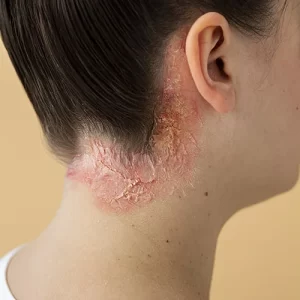 Atopic Dermatitis (Eczema)