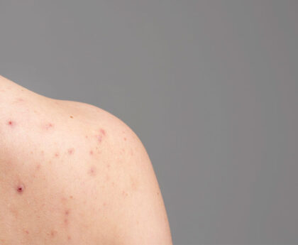 Chickenpox: Causes, Symptoms, Treatment & Prevention