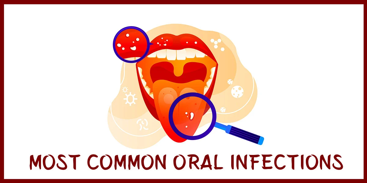 Most Common Oral Infections (Part 1)