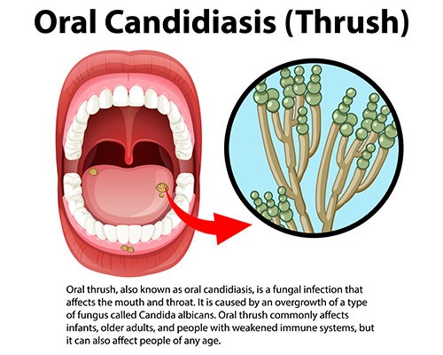 Most Common Oral Infections (Part 2)