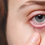 Eye Infection: Symptoms, Causes & Treatment