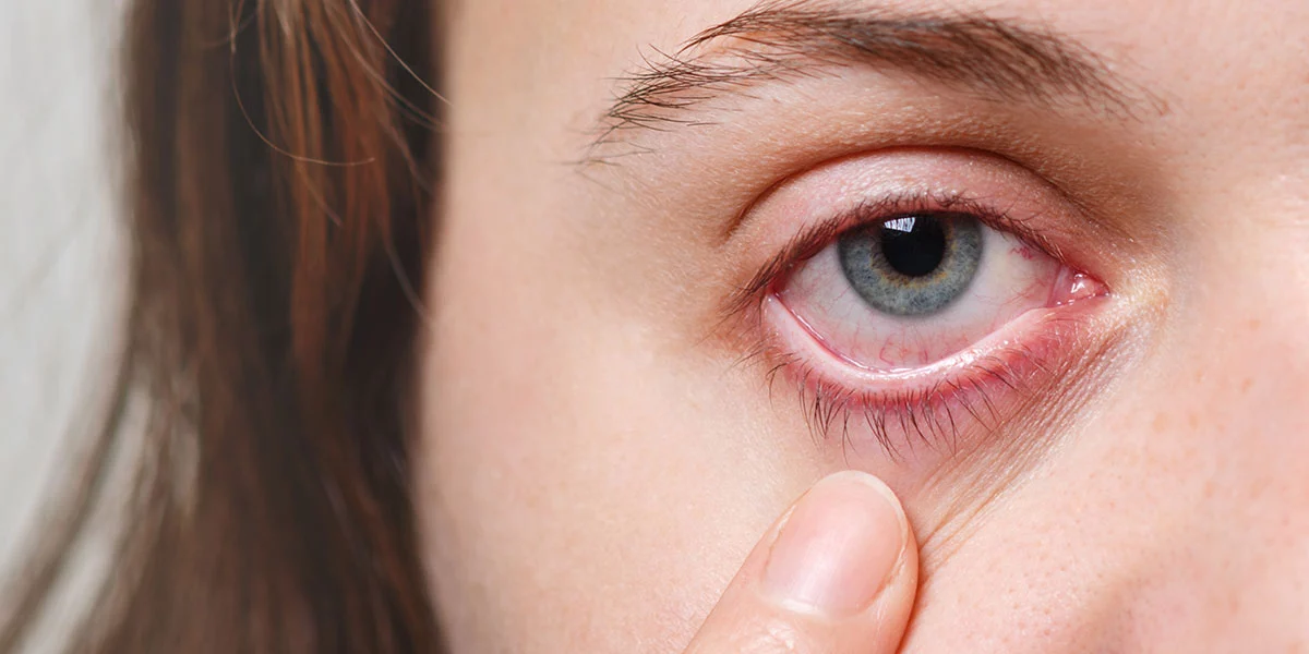 Eye Infection: Symptoms, Causes & Treatment
