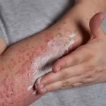 Skin Allergy - Common Skin Rashes, Causes & Treatment