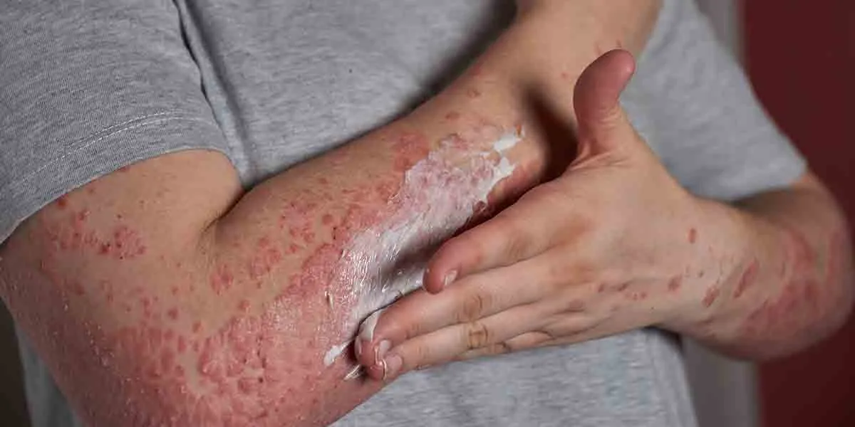 Skin Allergy - Common Skin Rashes, Causes & Treatment