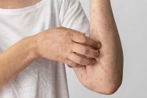 skin-allergy-reaction-persons-arm