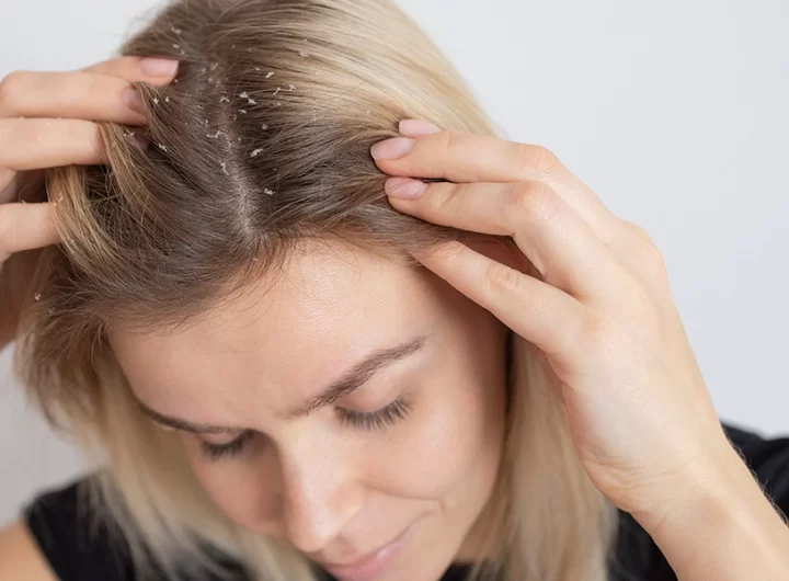 Dandruff: Types, Symptoms, Causes, & Prevention