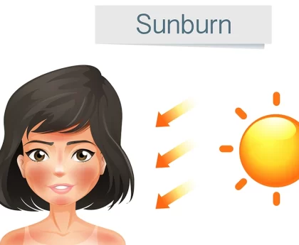 Sunburn: Symptoms, Causes, Prevention & Home Remedies