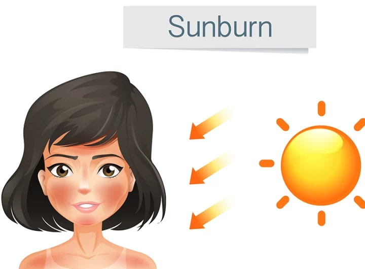 Sunburn: Symptoms, Causes, Prevention & Home Remedies