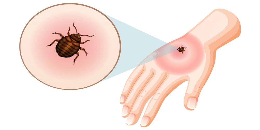 Chagas Disease: Types, Symptoms, Causes & Prevention