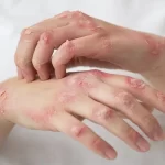 Leprosy: Types, Symptoms, Causes, & Prevention