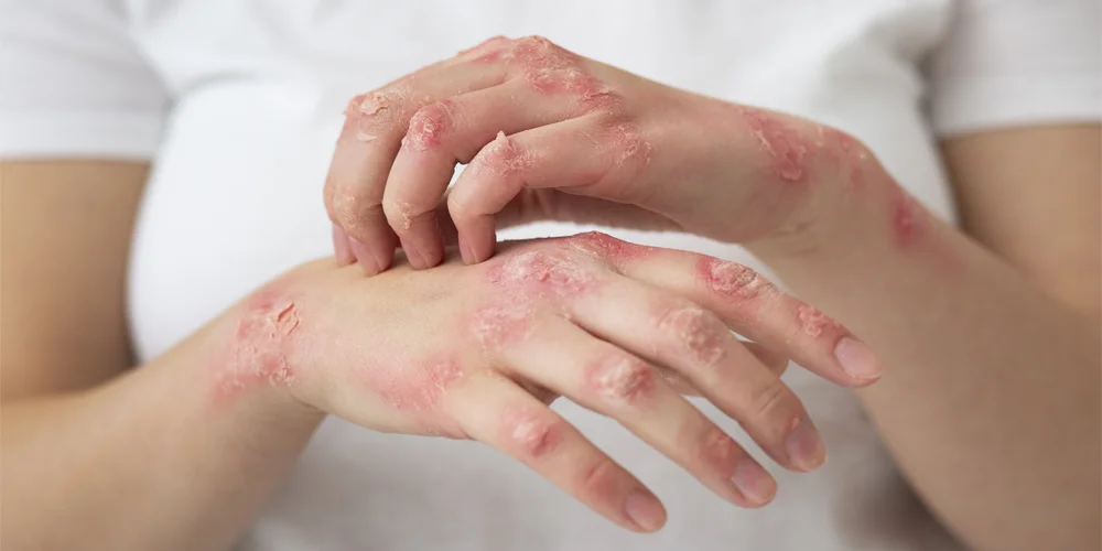 Leprosy: Types, Symptoms, Causes, & Prevention