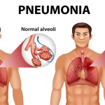 Pneumonia: Types, Symptoms, Causes & Home Remedies