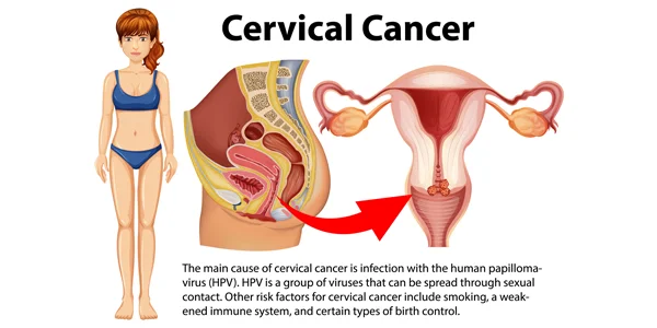 Cervical Cancer: Types, Symptoms, Causes, & Home Remedies